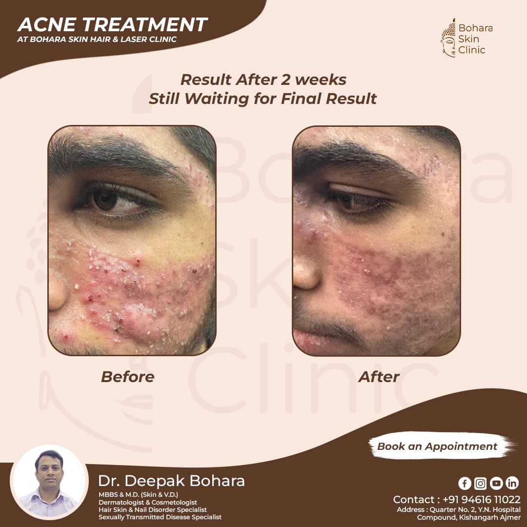 After treatment